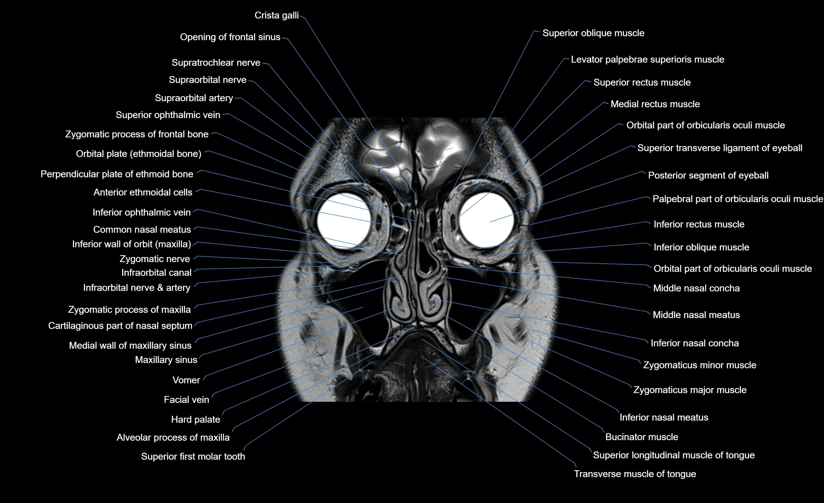 MRI face & paranasal sinuses(PNS) labelled  coronal  cross sectional anatomy 3T radiology  image-img-00001-00018.webp